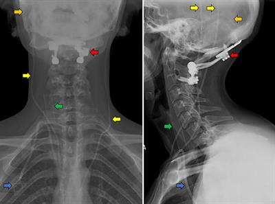 Characterizing a new clinical phenotype: the co-existence of cerebral venous outflow and connective tissue disorders